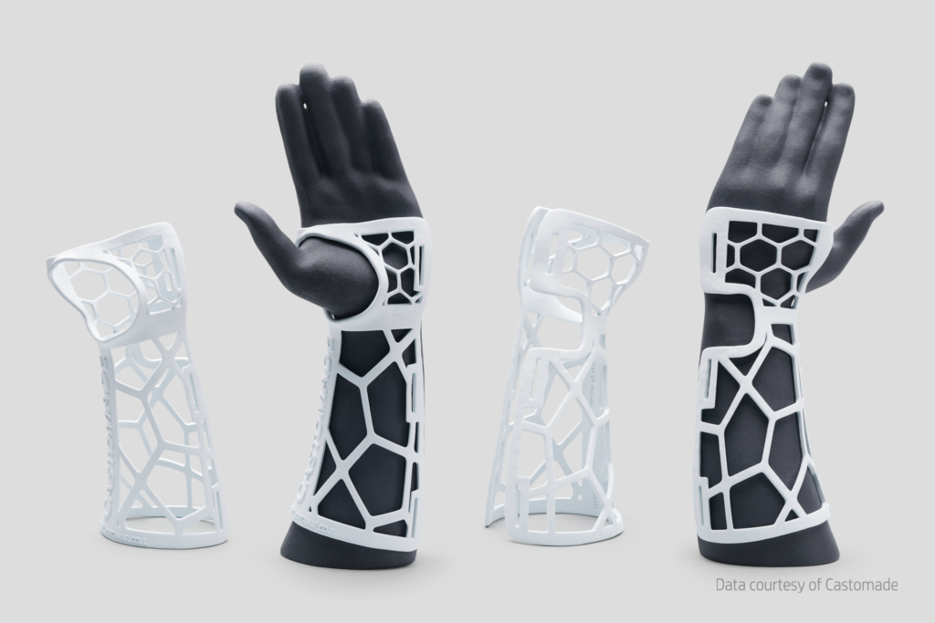 3d printed arm casts